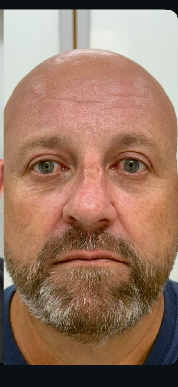 Blefaroplastia a laser depois do procedimento