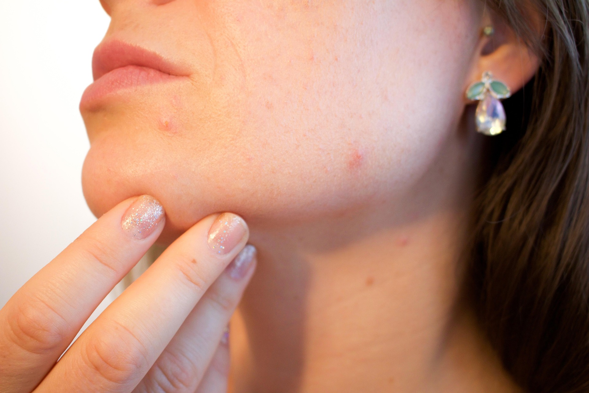 Acne na região da mandíbula em mulher adulta