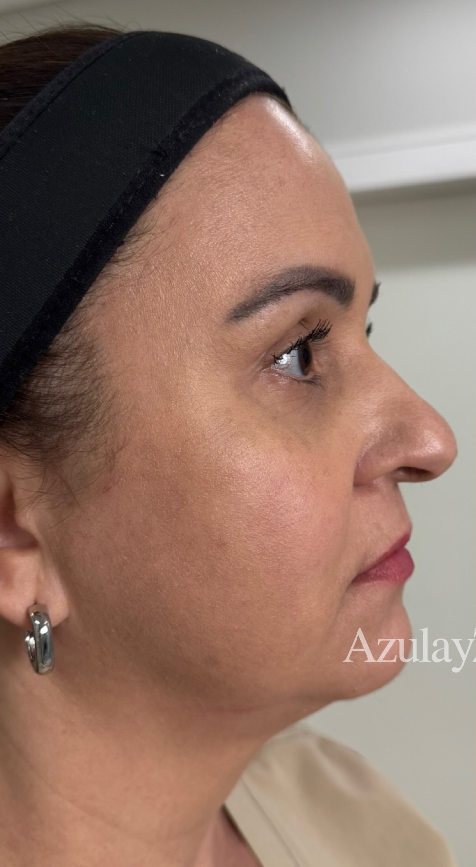 harmonizacao-facial-antes