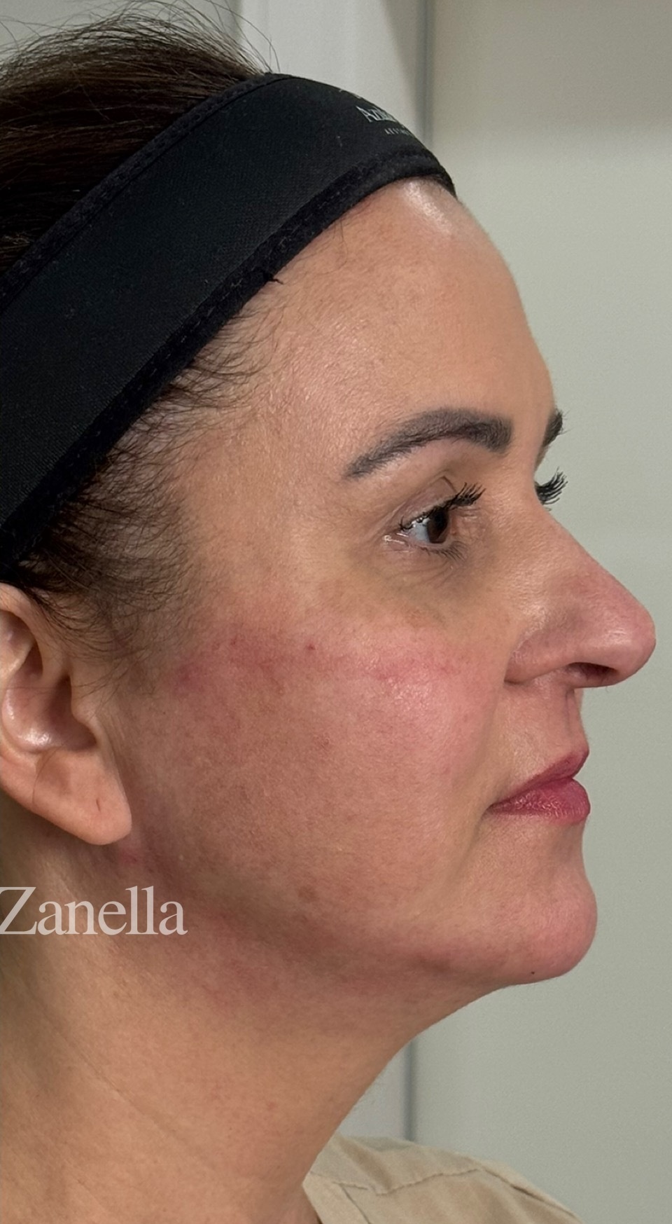 harmonizacao-facial-depois
