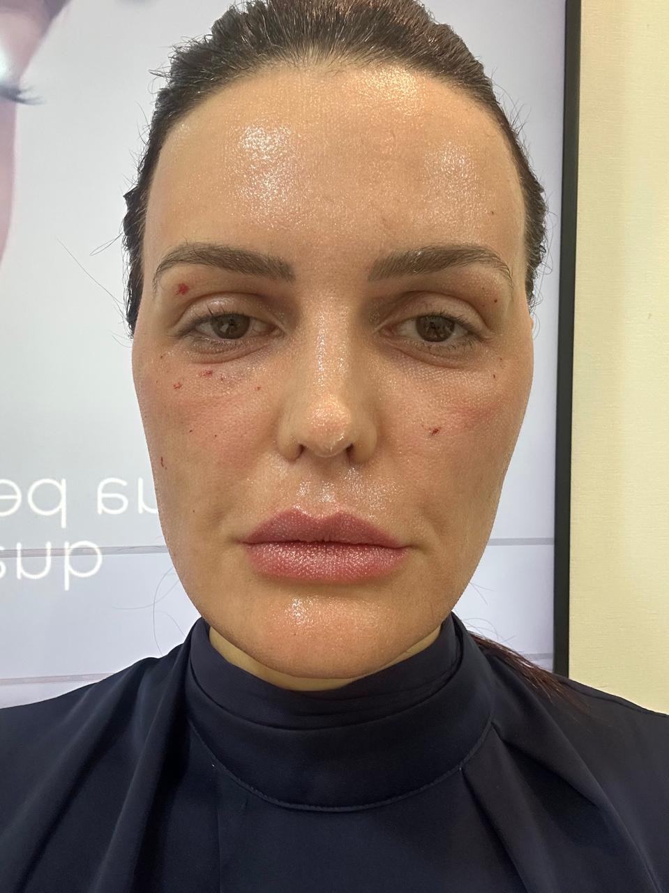 Pele com pontos de sangramento puntiforme e vermelhidão logo após o laser híbrido de CO2, pós imediato