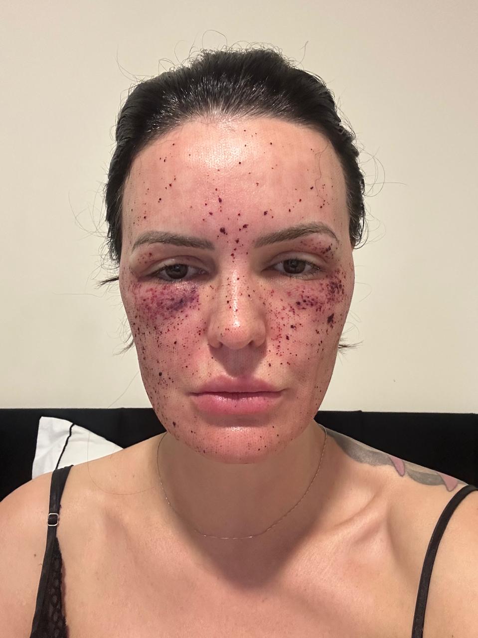 Pele com crostas escuras e olheira roxeada no dia seguinte ao laser híbrido de CO2