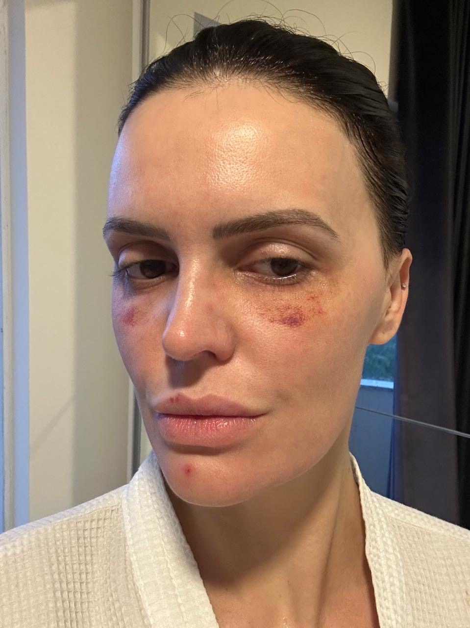 Pele com crostas clareando e vermelhidão residual ao redor dos olhos, quarto dia de recuperação após o laser híbrido de CO2