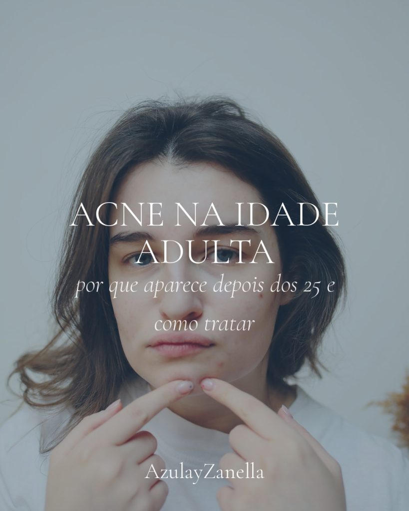 Capa do artigo sobre acne na idade adulta em Joinville