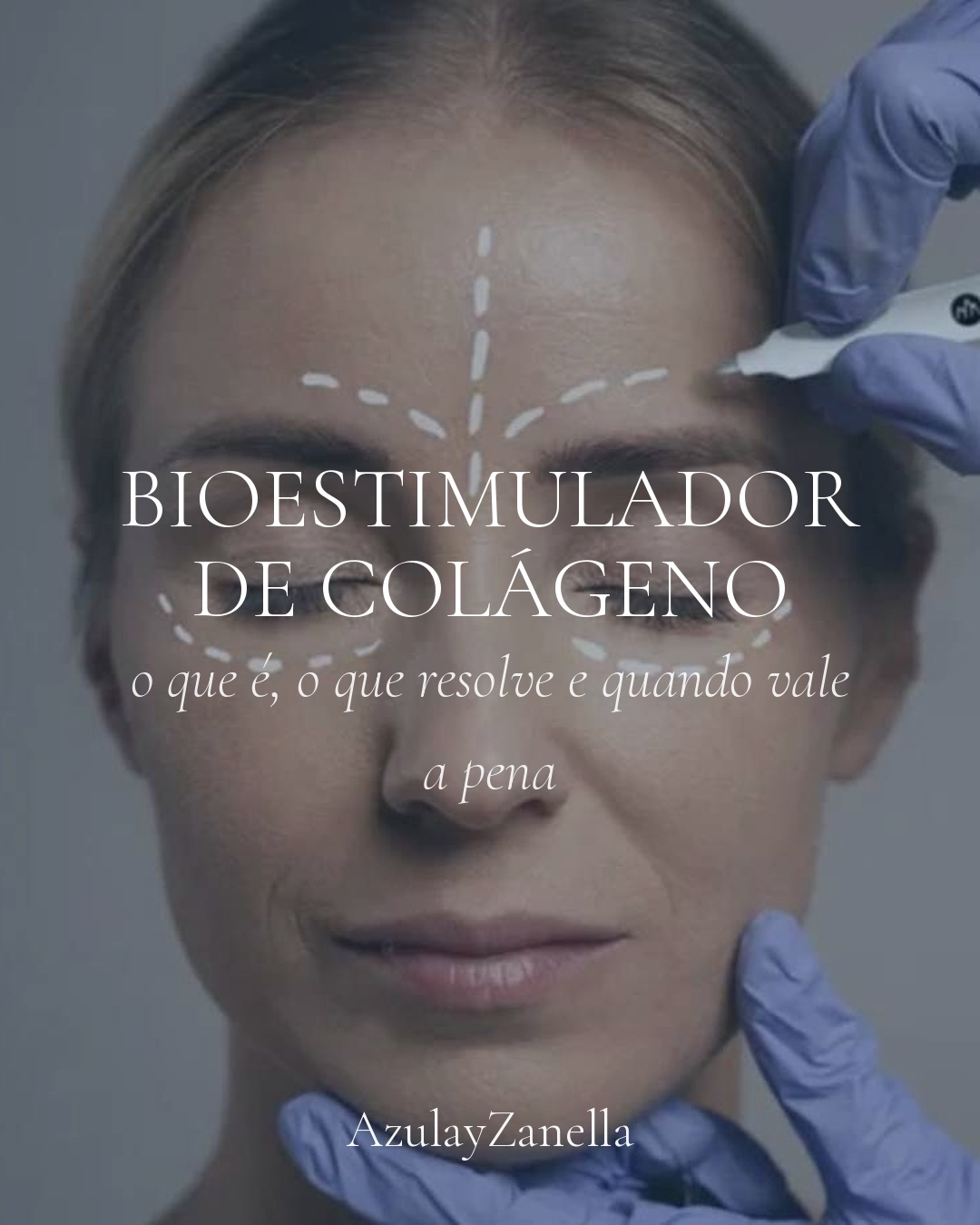 Bioestimulador de colágeno em Joinville, AzulayZanella