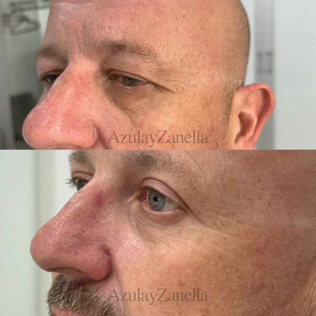 Blefaroplastia a laser antes e depois em Joinville - paciente real