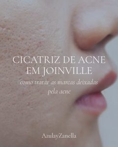 Capa do artigo sobre tratamento de cicatriz de acne em Joinville