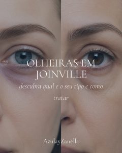 Olheiras em Joinville: descubra qual é o seu tipo e como tratar, AzulayZanella