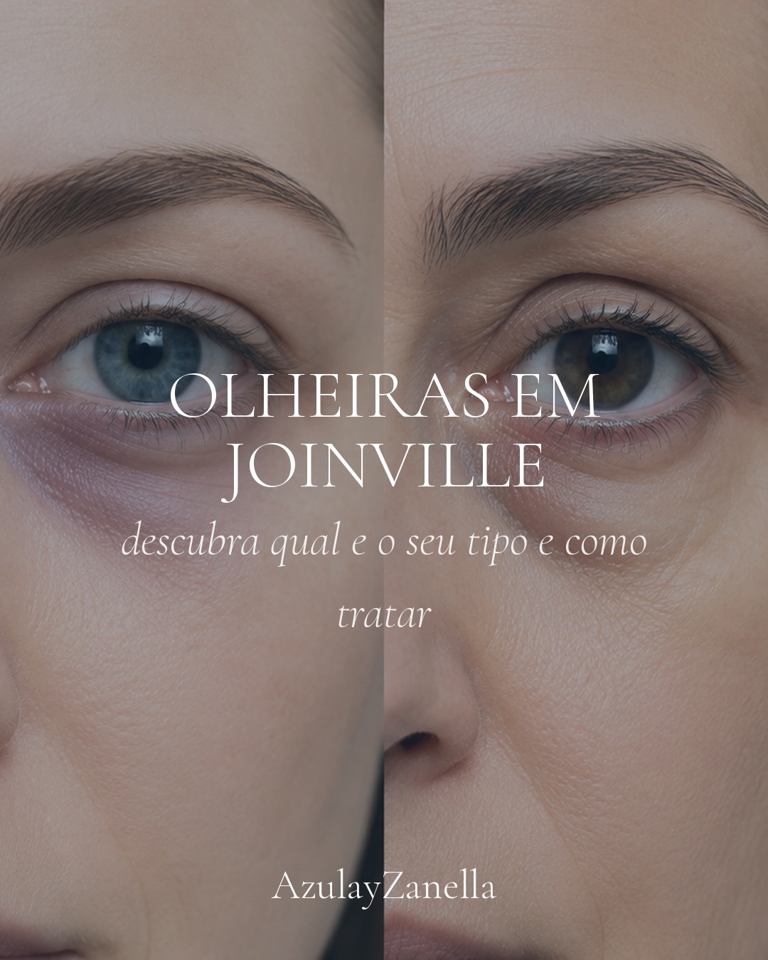 Olheiras em Joinville: descubra qual é o seu tipo e como tratar, AzulayZanella