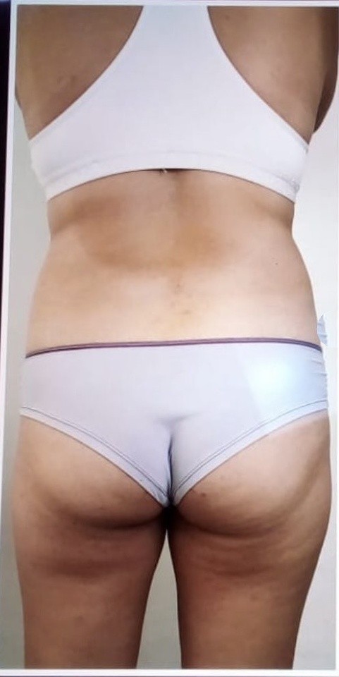 cmslim-cintura-gluteos-antes-clean