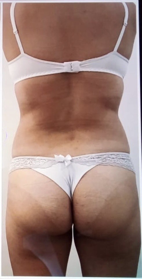 cmslim-cintura-gluteos-depois-clean