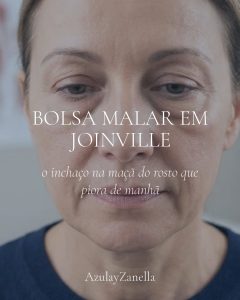 Bolsa malar em Joinville: mulher com inchaço na maçã do rosto, abaixo da pálpebra